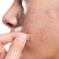 Pimple patches